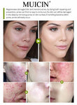 MUICIN - Acne treatment Pimple defence acne scar cream - 50g  Online @ Best Price in Pakistan